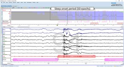 Overview of the hypnodensity approach to scoring sleep for polysomnography and home sleep testing